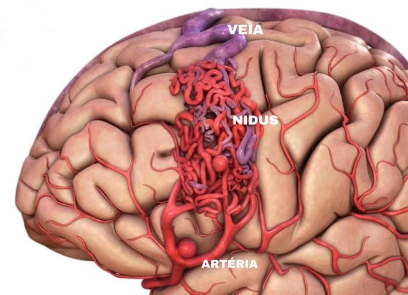 Tratamento para Malformação Arteriovenosa Cerebral