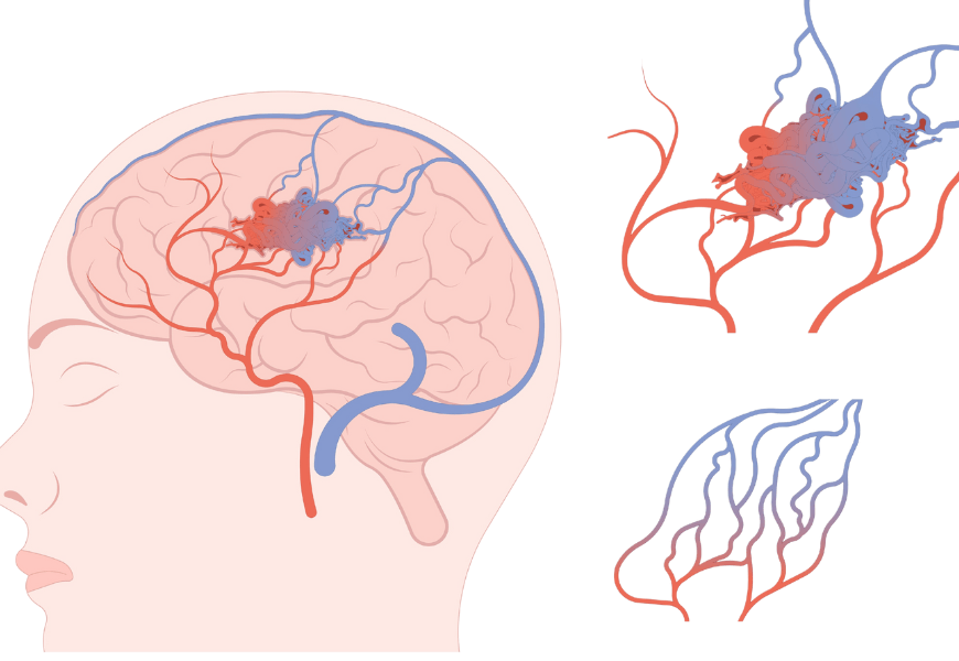 Malformação Arteriovenosa (MAV): Uma Visão Completa